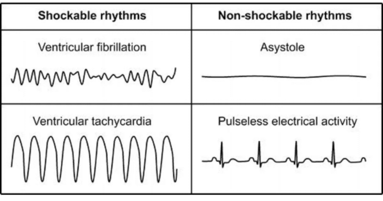 Schockbare Und Nicht Schockbare Rhythmen