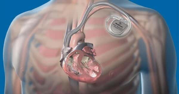 Types of Defibrillator – Overview & Uses | Calmed Equipment