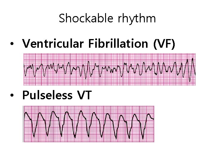 shockable rhythms